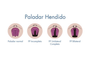 clasificacion paladar hendido