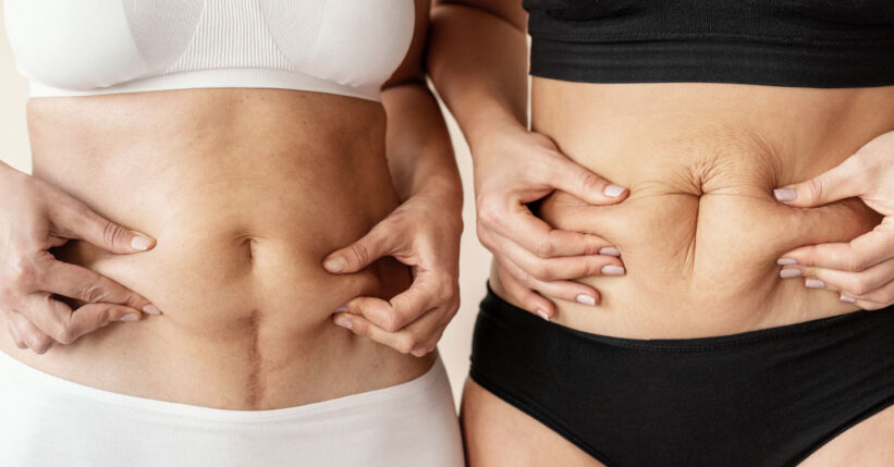 abdominoplastia y cesarea